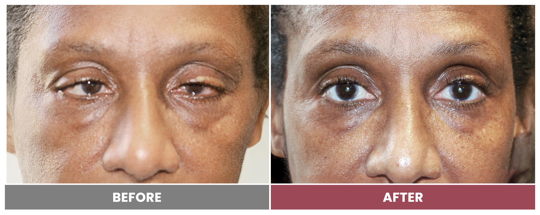 PTOSIS REPAIR - Case 1